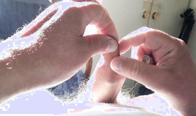 Batteries In Foreskin - 1 Of 3