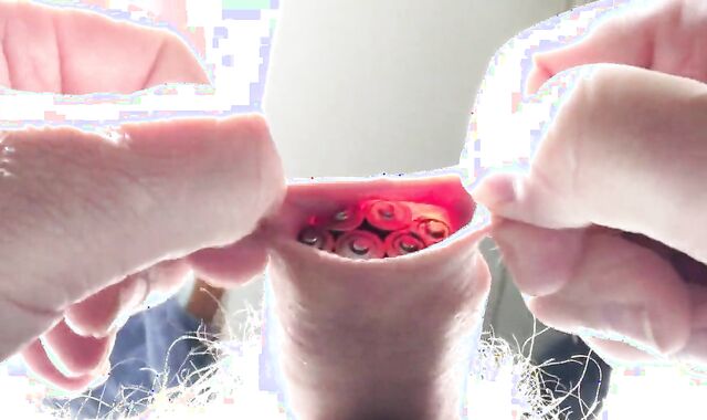 Batteries In Foreskin - 1 Of 3