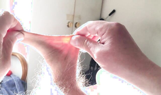 Batteries In Foreskin - 1 Of 3