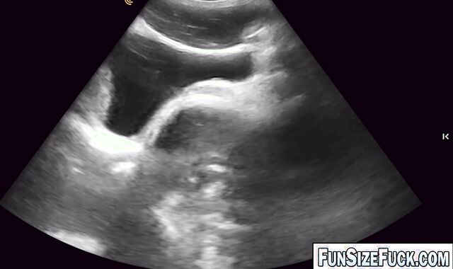 Something Was MOVING Inside His Belly!